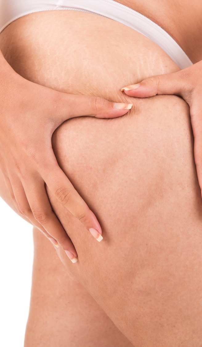 Woman showing her cellulite Woman showing her cellulite